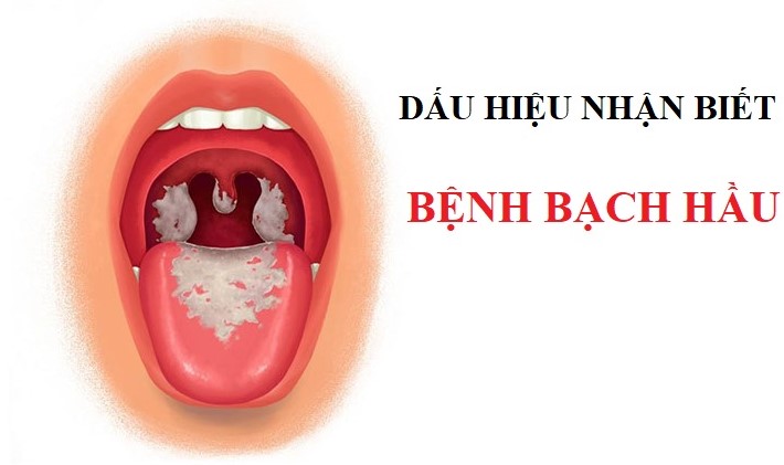 Cách nhận biết những dấu hiệu của bệnh bạch hầu đang gây sốt những ngày qua